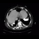 Pachypleuritis, calcified, pachypleuritis calcarea: CT - Computed tomography